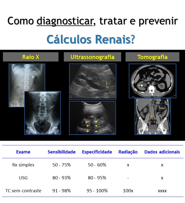 Como diagnosticar, tratar e prevenir um cálculo renal? | o urologista