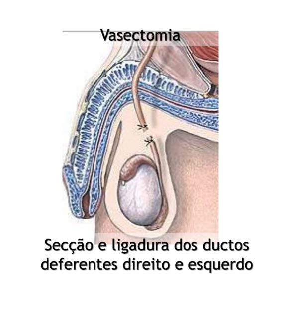 vasectomia-2