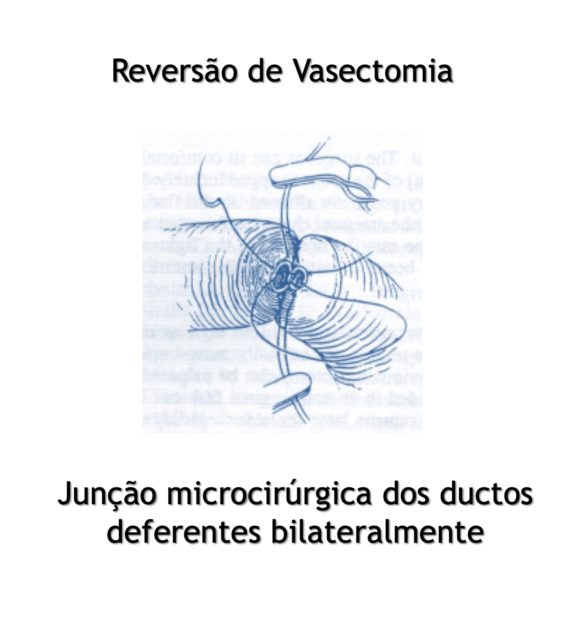 reversão-de-vasectomia