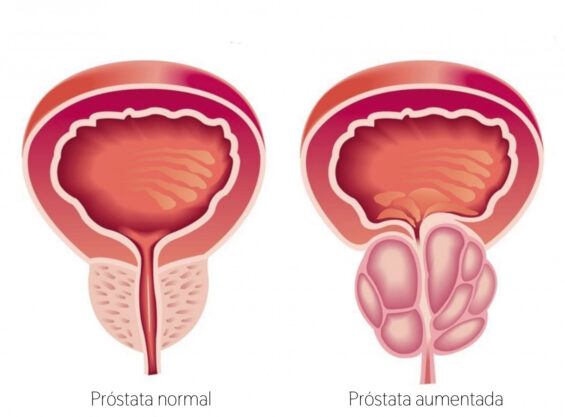 Dr Giovanni Marchini HoLEP para HPB Prostata normal e aumentada - doenças da próstata - aumento da próstata

