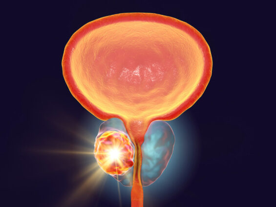 Cuidados com a próstata - Imagem da próstata com um câncer localizado no lado esquerdo. 