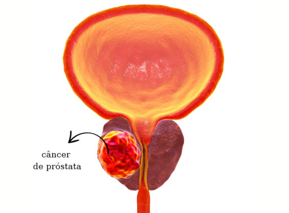 Doenças da próstata - imagem ilustrativa da próstata com indicação do câncer de próstata